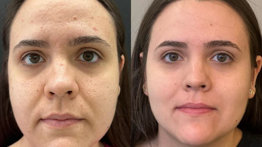 Antes e depois de tratamento de acne