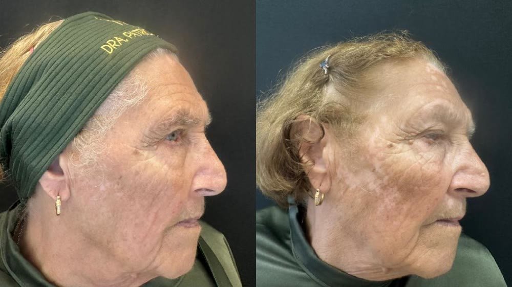 Antes e depois de tratamento de manchas