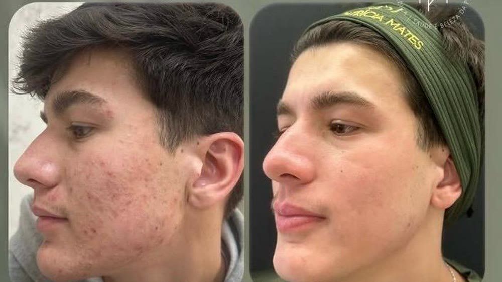 Antes e depois de tratamento de acne, 6 meses após